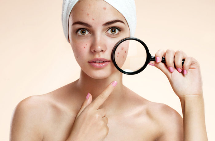 Acne: trattamento pelli impure